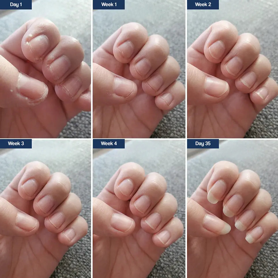 Dual Defense Nail System