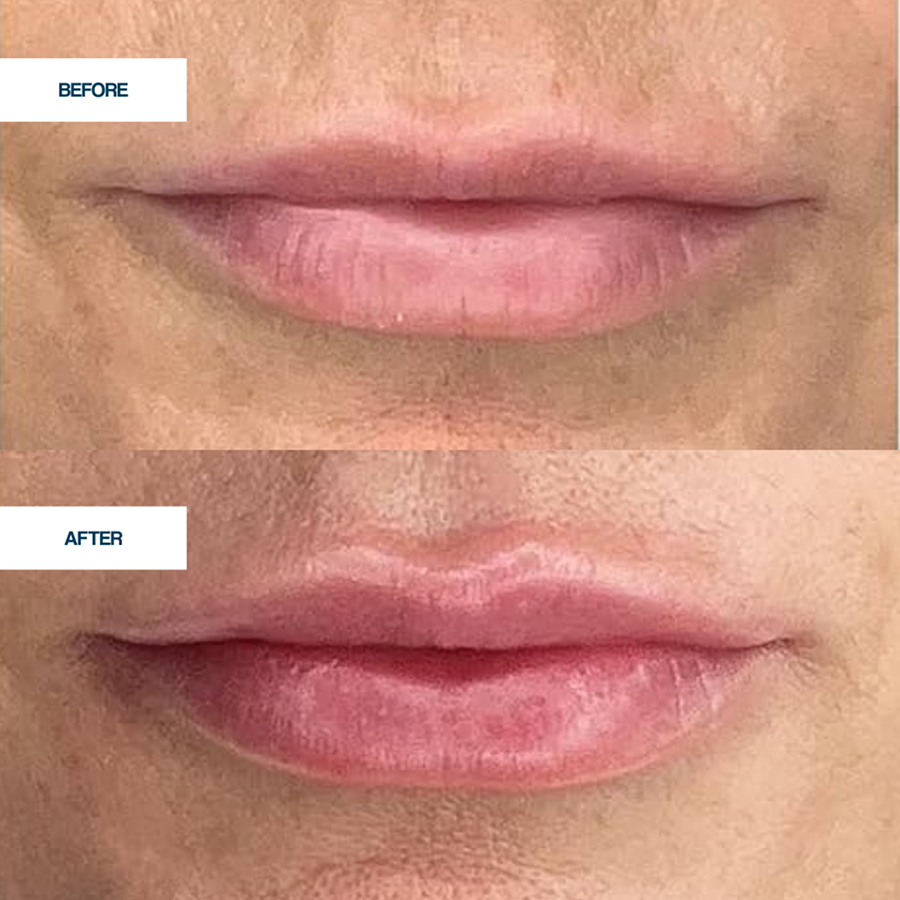 LipRegen Lip Plumper with TriplePlump™ System