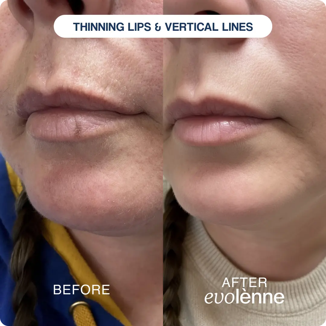 PeptiGlow™ Infusion System