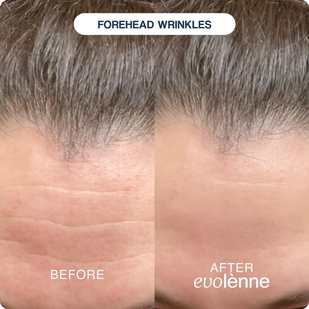 PeptiGlow™ Infusion System